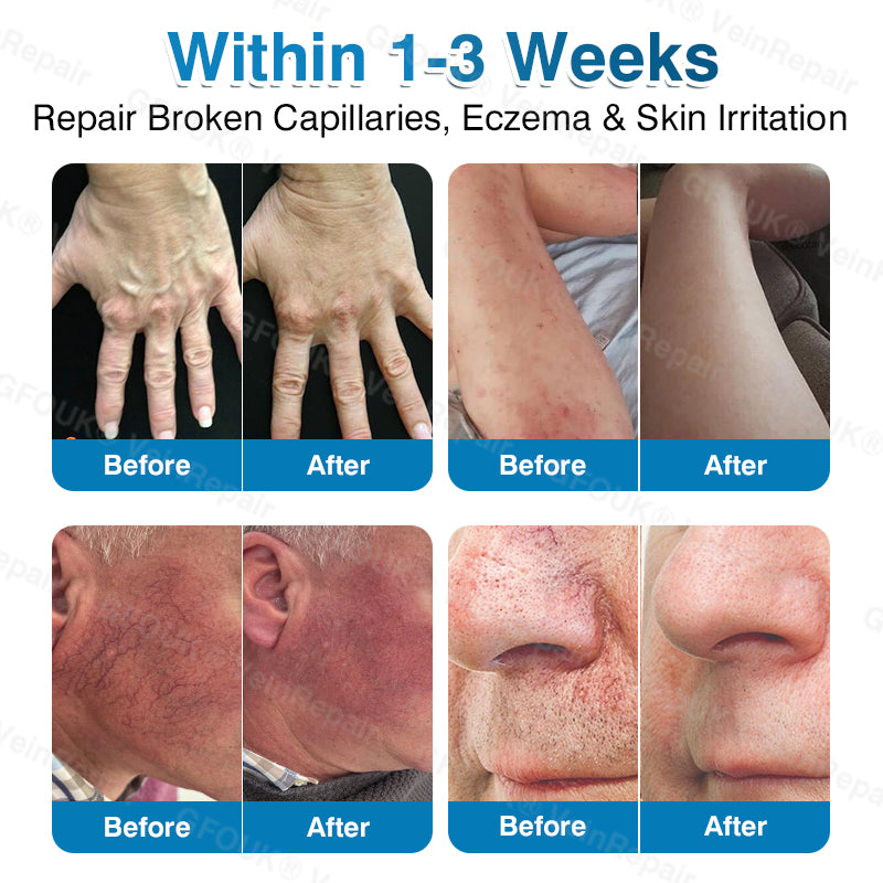 🇬🇧🏆🦵🛡️GFOUK® VeinRepair Microneedle Patch Roll⚡Instant Relief, Long-Term Results