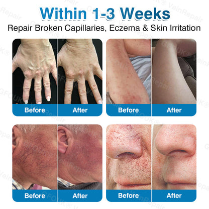 🇬🇧🏆🦵🛡️GFOUK® VeinRepair Microneedle Patch Roll⚡Instant Relief, Long-Term Results