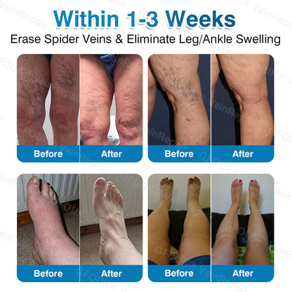 🇬🇧🏆🦵🛡️GFOUK® VeinRepair Microneedle Patch Roll⚡Instant Relief, Long-Term Results