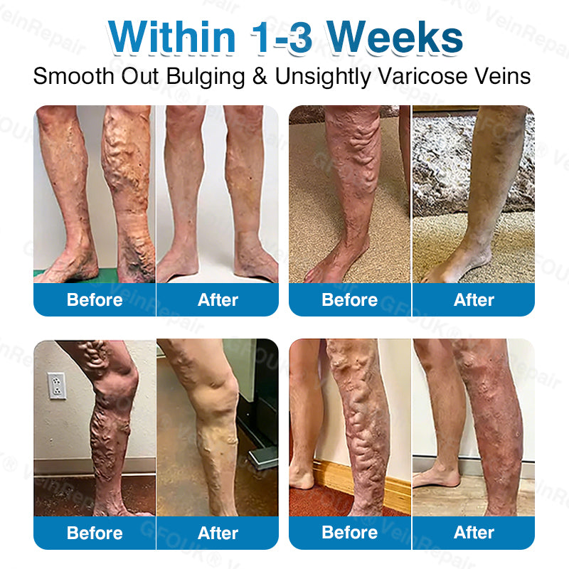 🇬🇧🏆🦵🛡️GFOUK® VeinRepair Microneedle Patch Roll⚡Instant Relief, Long-Term Results